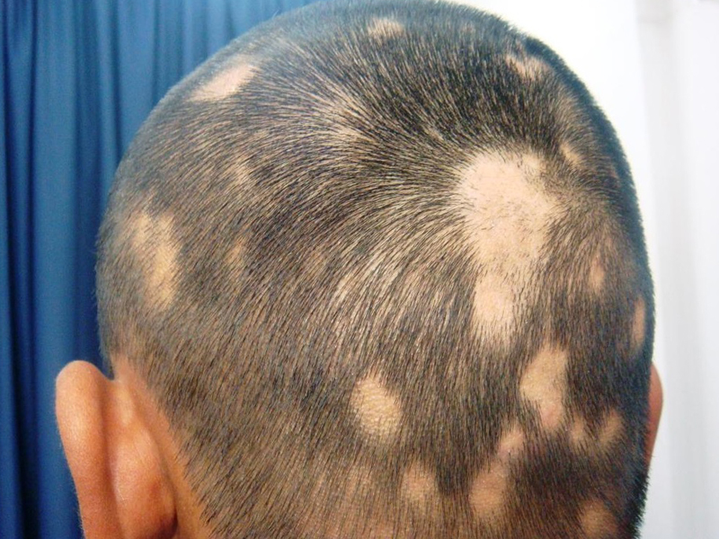 Van Zeeman Rot Alopecia Areata 